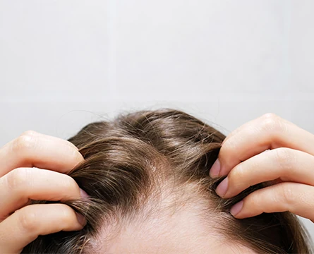 woman touching scalp with thinning hair